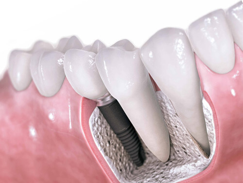 Зубные импланты производства Nobel Biocare