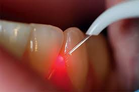 Лазерное лечение зубов самара