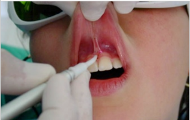 Лазерное лечение зубов самара