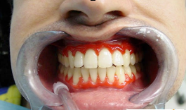 Лазерное лечение зубов самара thumbnail